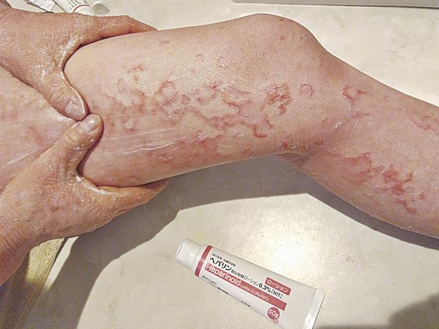 OTC類似薬の塗り薬で全身の肌を保湿する大藤龍之助さん