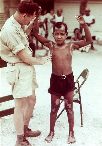 「死の灰」を浴びてやけどしたロンゲラップの少年。1954年3月の避難から数年後に亡くなったという(豊崎博光さんが米国立公文書館で入手)